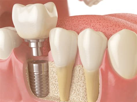 bone grafting for dental implants houston tx